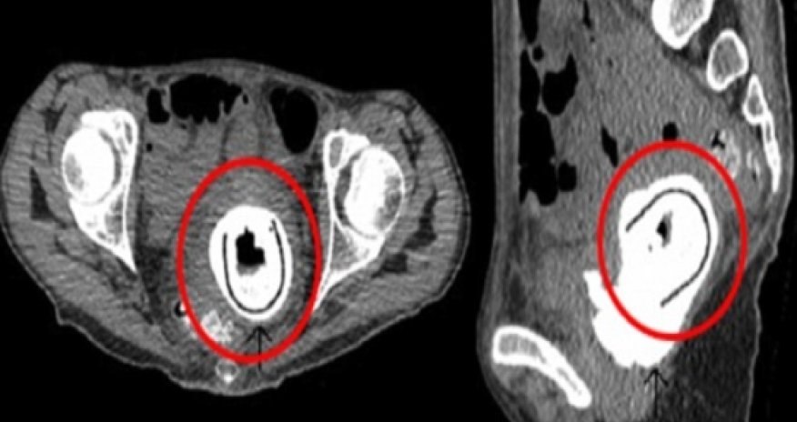 Woman had toy inside her for 10 YEARS