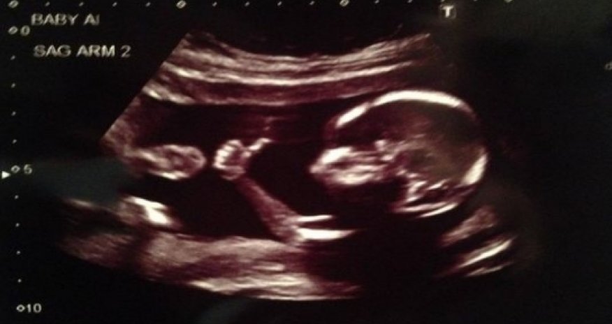 Baby gives thumbs-up in ultrasound photo