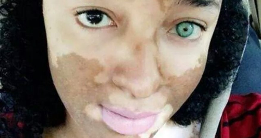 Girl born ‘with a permanent tattoo of a dog kissing a bunny’ - PHOTO