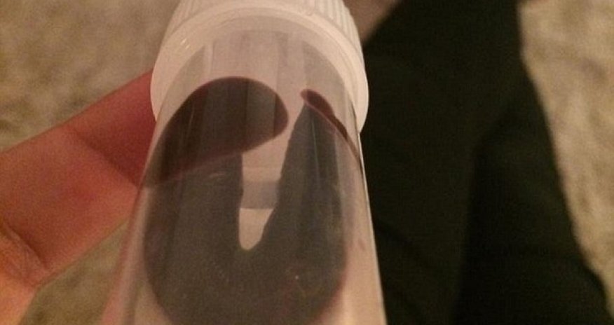 I had a three-inch leech up my nose for a MONTH - PHOTO+VIDEO