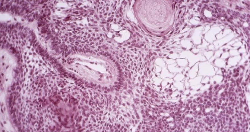 Cancer-killing stem cells engineered in lab