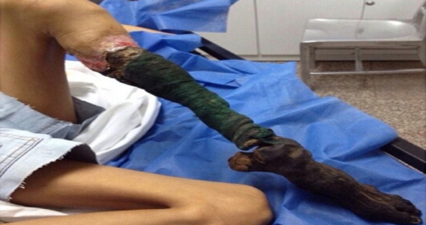 Girl's leg shrivels and turns BLACK - VIDEO