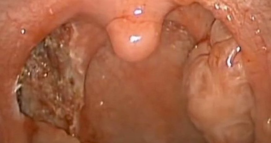 WARNING!!! Surgeon's graphic videos showing tonsils being taken out - VIDEO