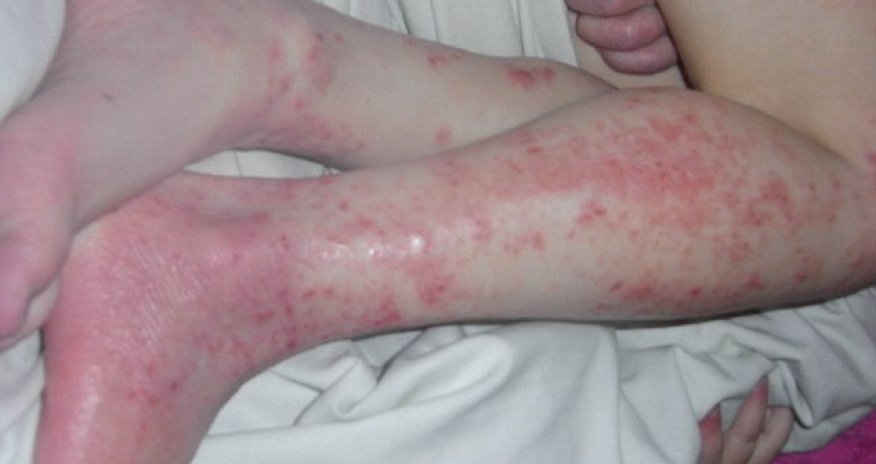 Eczema girl's agony is over - VIDEO