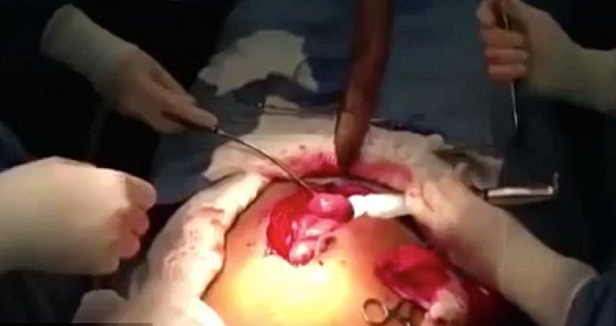 Huge LIVE fish is removed from a man's intestine - PHOTO+VIDEO