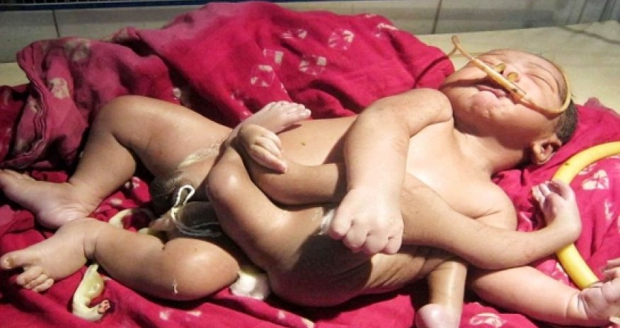 Baby born with four arms and four legs - VIDEO