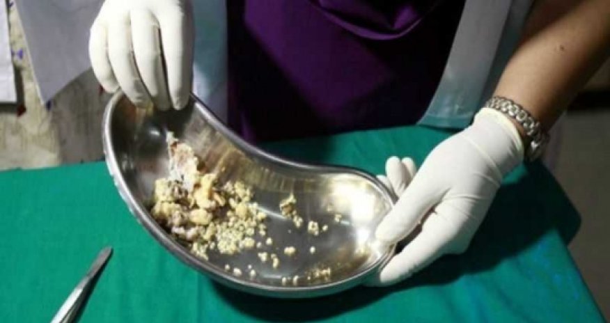 Хирурги вырвали у семилетней девочки 202 зуба- ФОТО