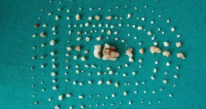 В Индии врачи вырвали у 7-летней девочки 202 зуба -ФОТО