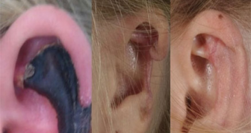 Woman's ear turns black spider bite