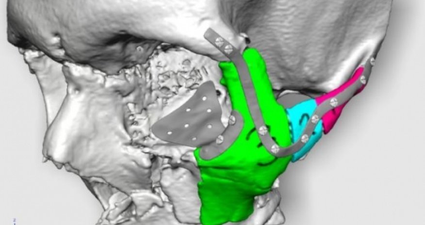 Surgeons will reconstruct road accident victim's face using 3D printing