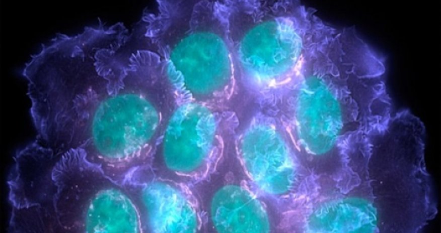 Cancer diversity 'threatens drugs'