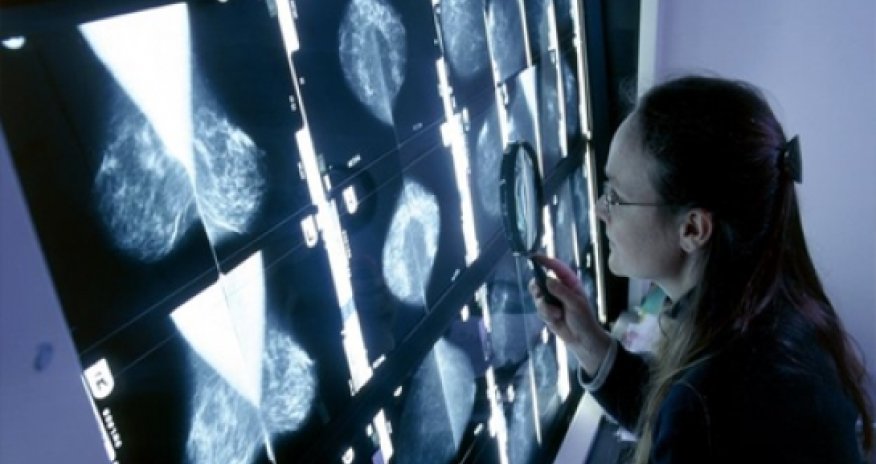 Cholesterol 'fuels' breast cancer