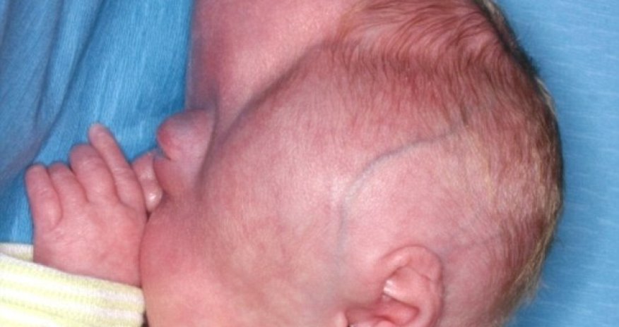 Baby with misshapen head undergoes pioneering surgery - PHOTO