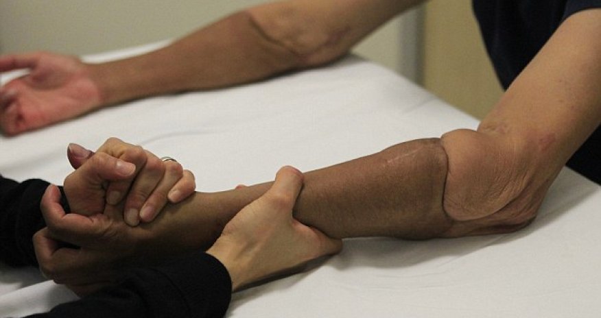 The man with two new ARMS - PHOTO