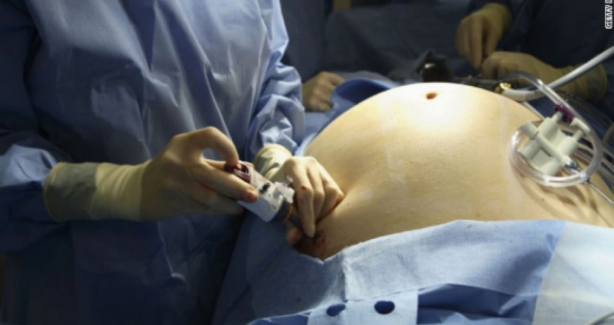 Bariatric surgery isn't 'one size fits all'