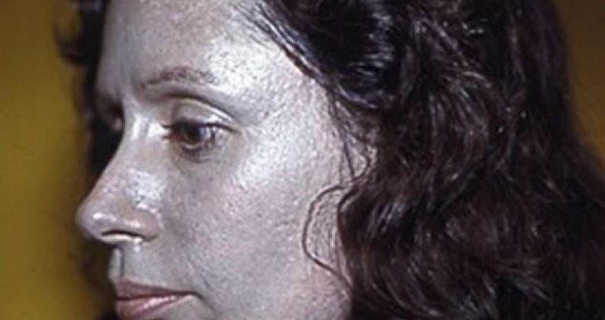 'Nose drops made my skin to turn silver' - PHOTO