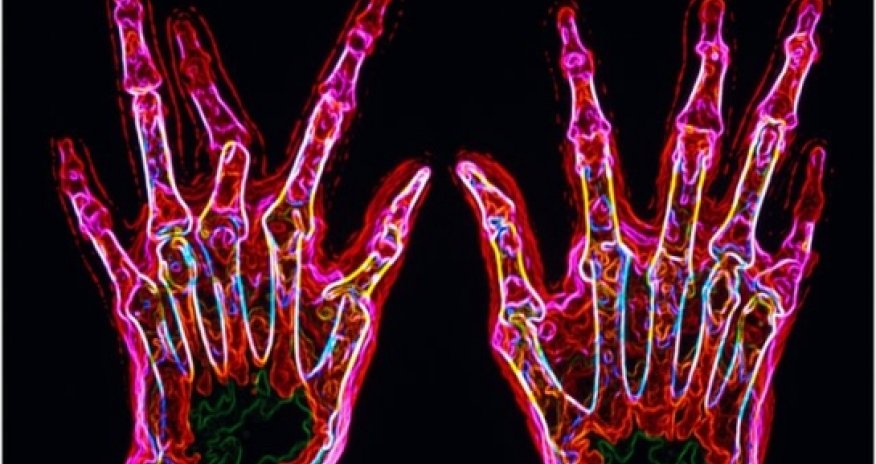 New genetic clues for rheumatoid arthritis 'cure'