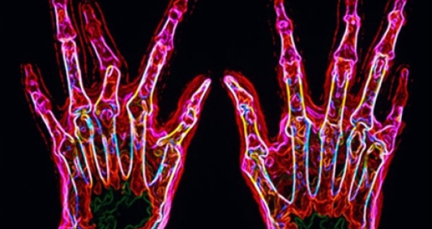 New genetic clues for arthritis