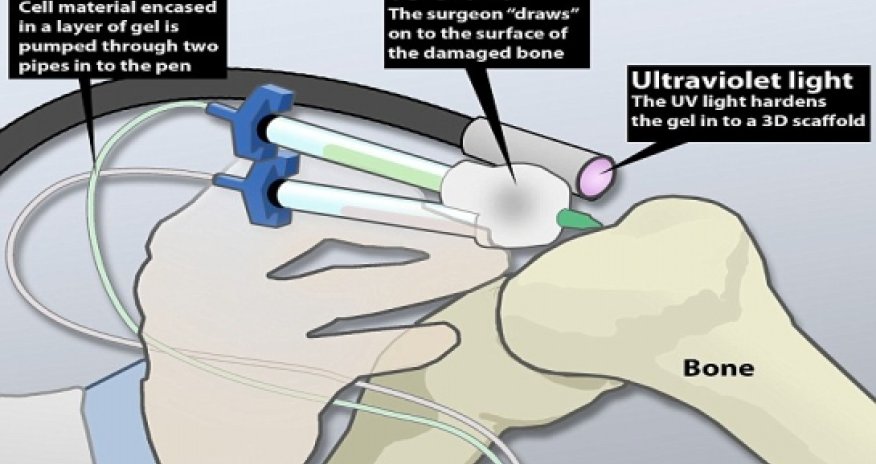'Bio-pen' could allow doctors to draw-on human cells