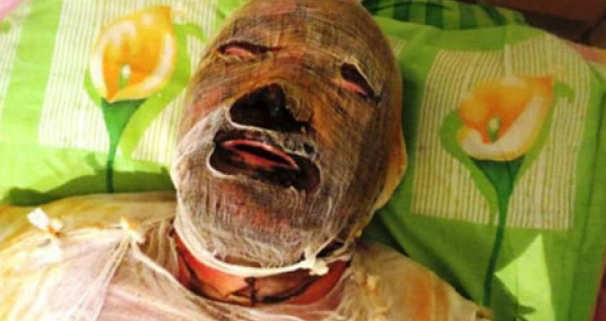 Karabakh war veteran dies of burns in hospital