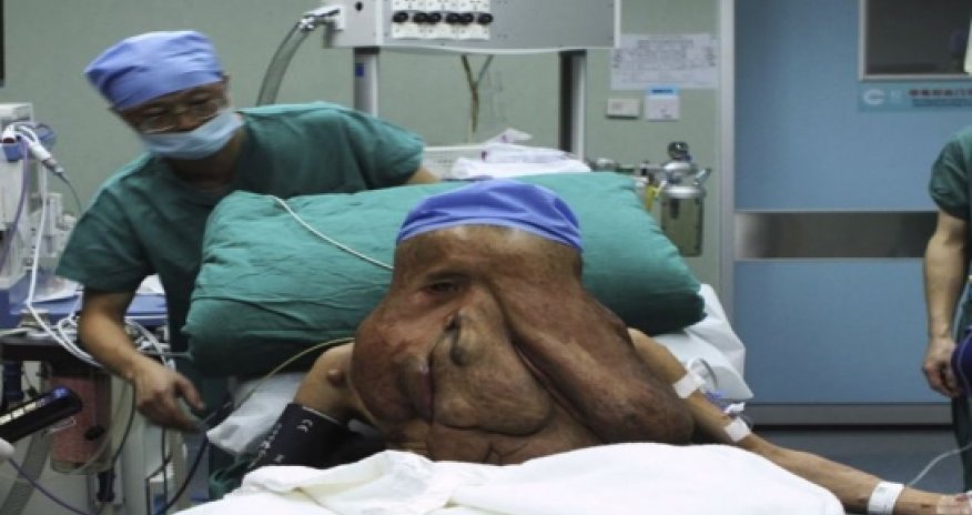 China's 'tumour man' undergoes more surgery - PHOTO