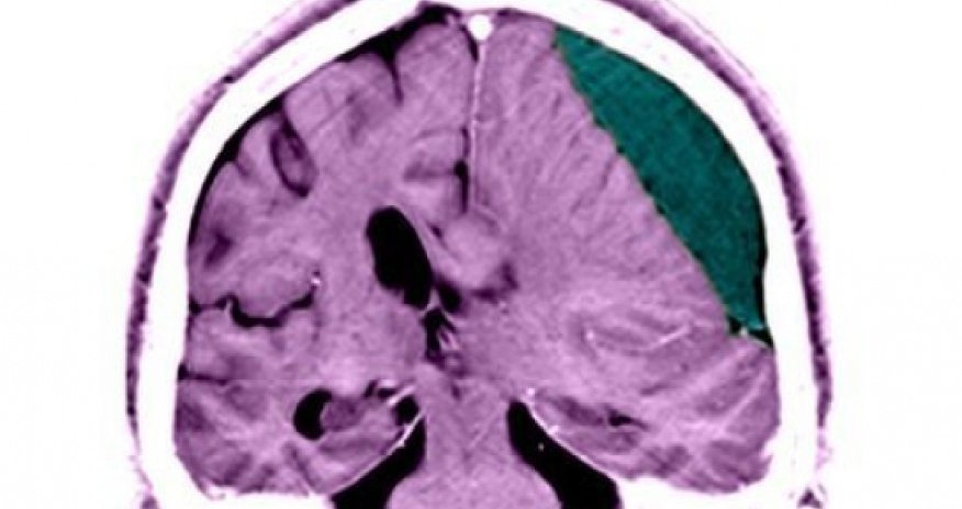 Brain blow leaves life-long dangers