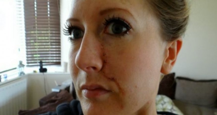 Tanning addict left with massive tumour on her face