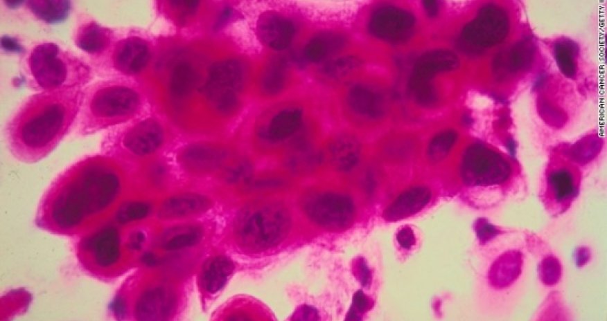 Most cancers in our world pandemic are preventable