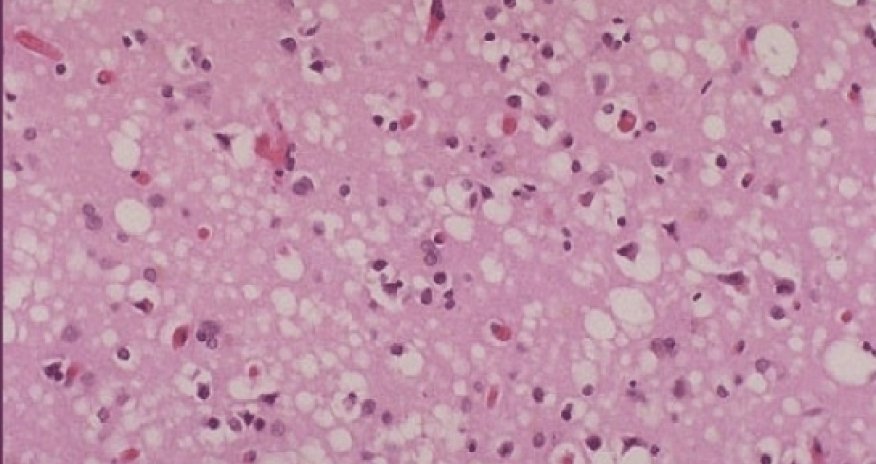 18 may have been exposed to incurable disease