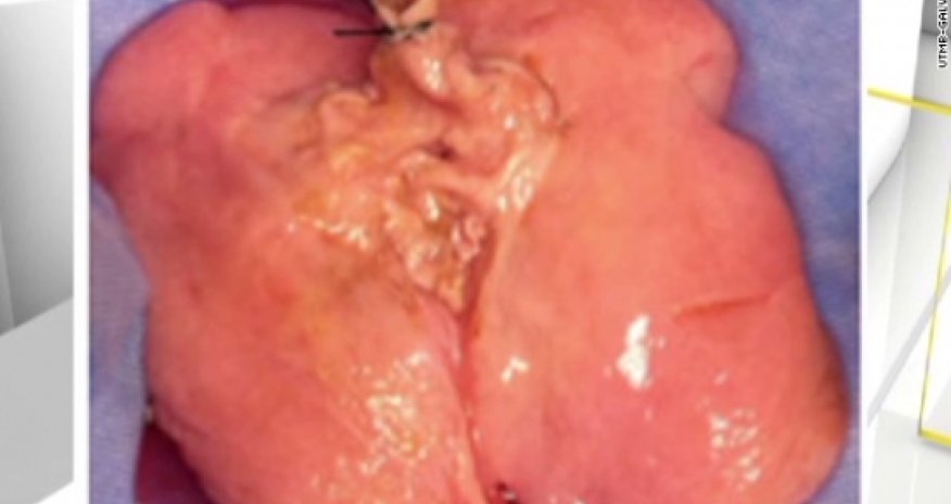 Human lung made in lab for first time