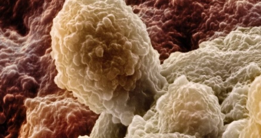 DNA prostate test 'will predict deadliest cancer risk'