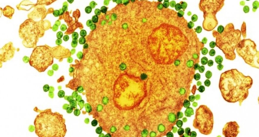 Immune upgrade gives 'HIV shielding'