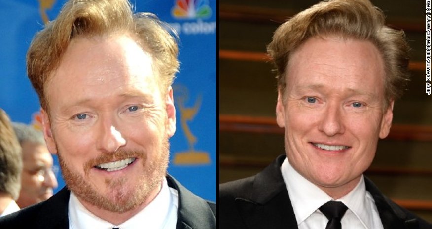 Beard envy? Surgery may be the answer - PHOTO