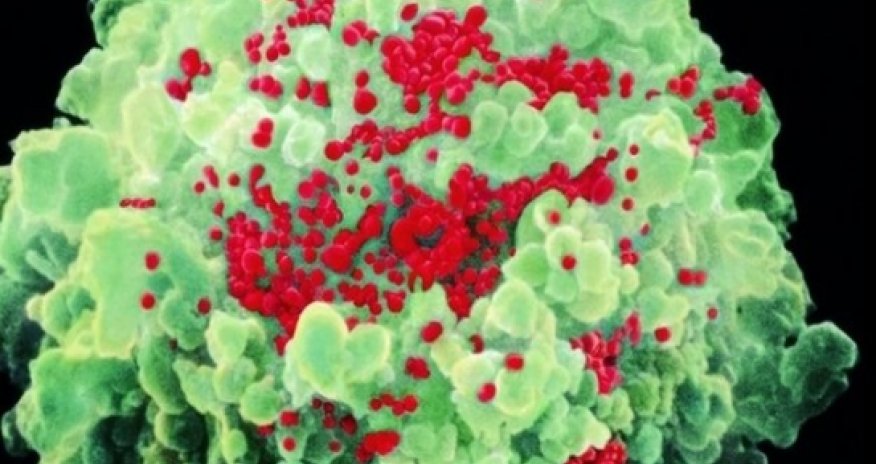 Rare 'likely' female-to-female HIV case reported