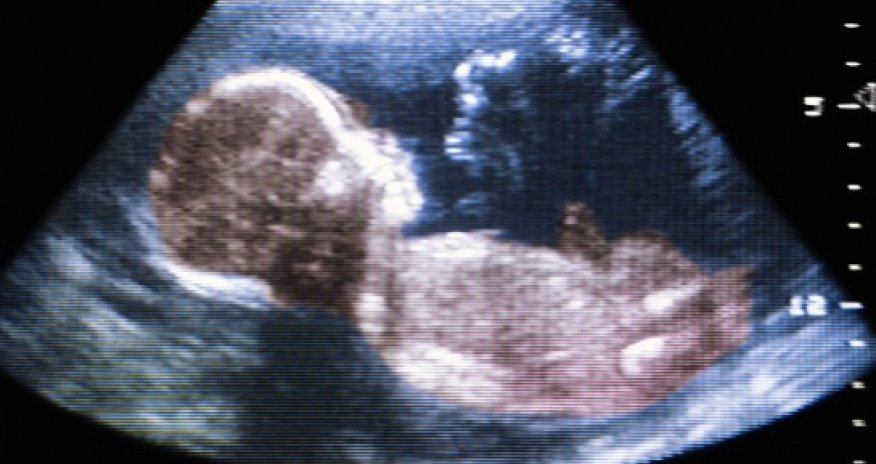 Autism may be caused by environmental factors