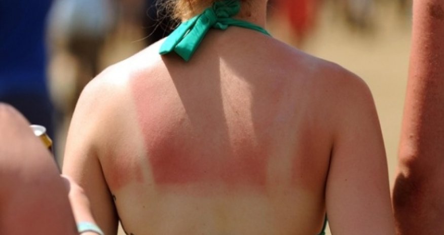 Skin cancer rates 'surge since 1970s'