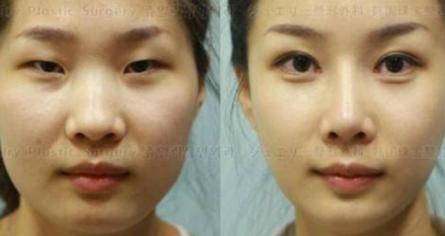 Plastic surgery in South Korea is so good - PHOTO