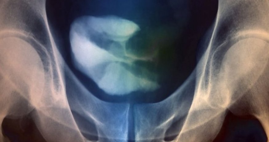 Bladder cancer: 'Exciting' drug breakthrough