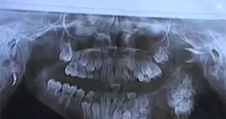 Doctors remove 80 teeth from boy's jaw