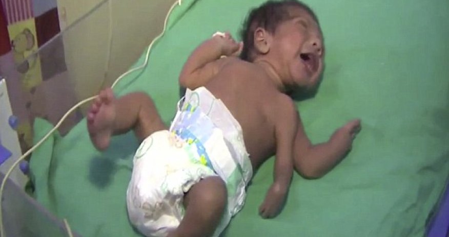 Baby born with THREE arms