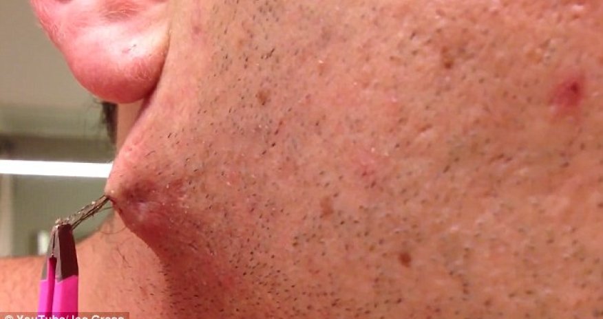 Man pulls the world's longest ingrown HAIR out of his face goes viral