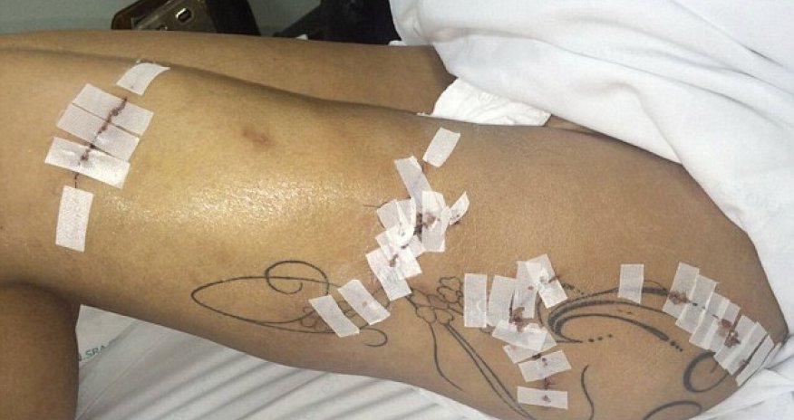 Miss BumBum contestant reveals the shocking damage caused by fillers injected