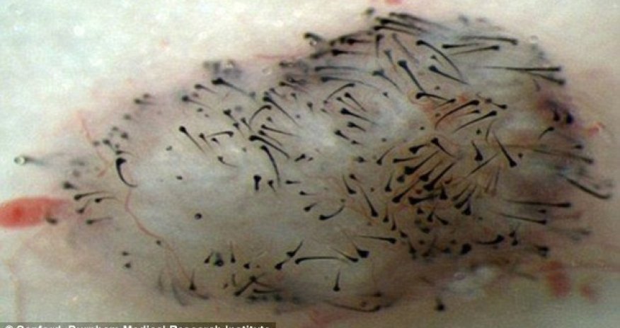 A cure for hair loss?