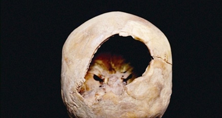 Hole in skull may have been created by craniotomy