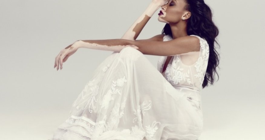 Chantelle Winnie: ‘I’m proud of my skin’