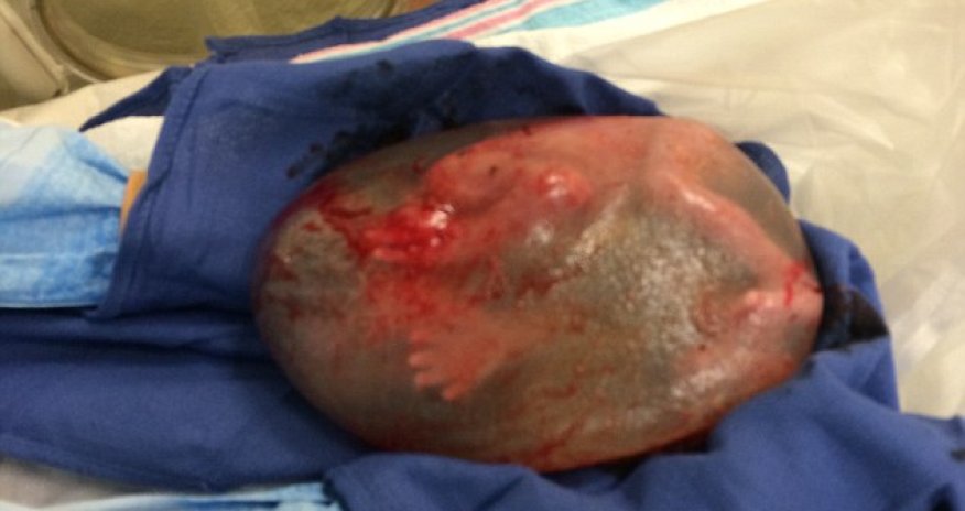 Baby born still INSIDE his amniotic sac