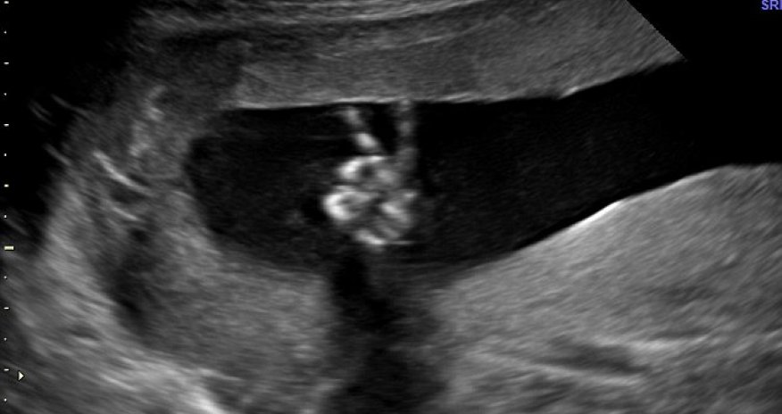 The baby pictured doing a victory V-sign in the womb