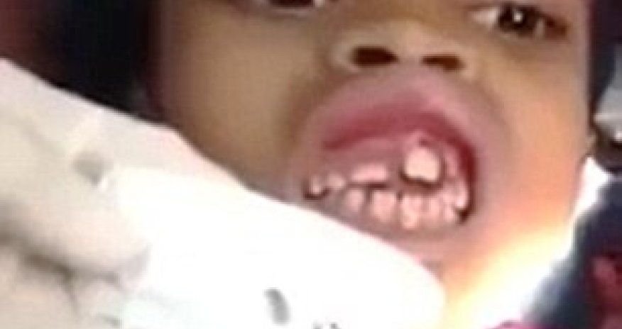 Dentist removing 15 MAGGOTS from inside little girl's gum