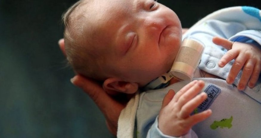 Baby born without a nose, mom says he's perfect