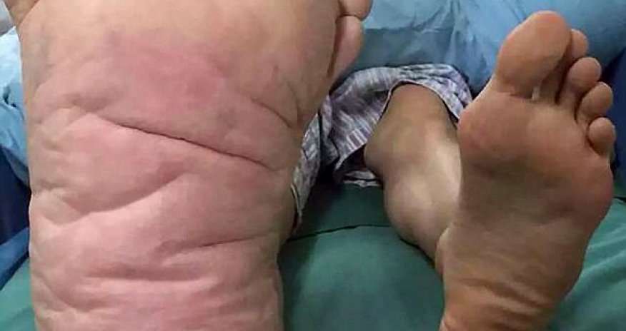 The man whose foot swelled to an astonishing size TWENTY-NINE